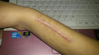 手臂疤痕