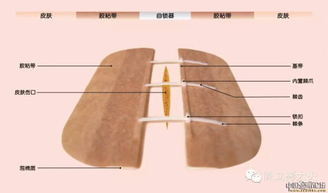 疤痕减张处理方法之减张器使用详解[tag]