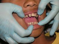 硅胶牙套的危害   硅胶牙套有哪些优点