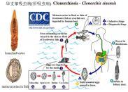 华支睾吸虫病