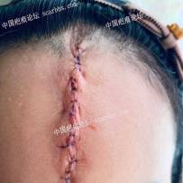 21年9月2号在上海九院刘伟医生那里做的手术。