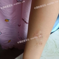 手臂上的这种疤痕应该怎么治疗啊？