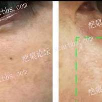 脸上凹陷疤痕也是色素疤痕治疗效果分享
