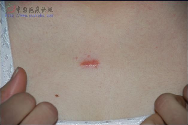 我的原发性疤痕疙瘩广州注射（图片，更新中） 