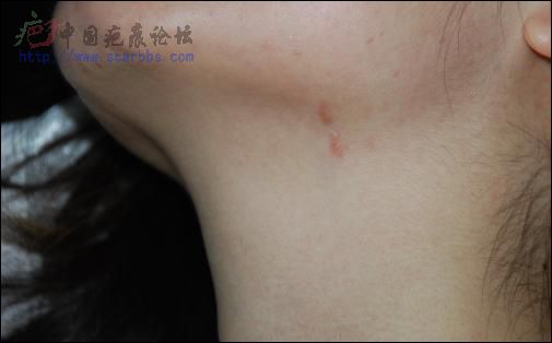 我的原发性疤痕疙瘩广州注射（图片，更新中） 