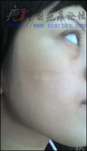 【术后疤痕】六个月了，给大家晒晒图片(更新至1年的照片) 