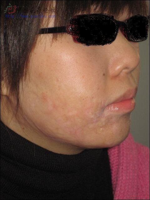 【烫伤疤痕】24年旧疤在北京疤康治疗的过程 