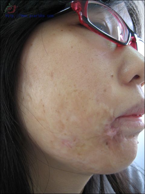 【烫伤疤痕】24年旧疤在北京疤康治疗的过程 