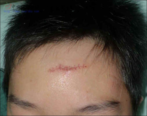 额头瘢痕切除到恢复的全过程 额头瘢痕切除,杨东运教授