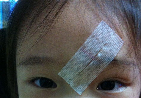 宝宝受伤了，额头缝六针,疤痕修复进行中...... 