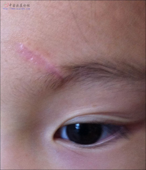 宝宝受伤了，额头缝六针,疤痕修复进行中...... 