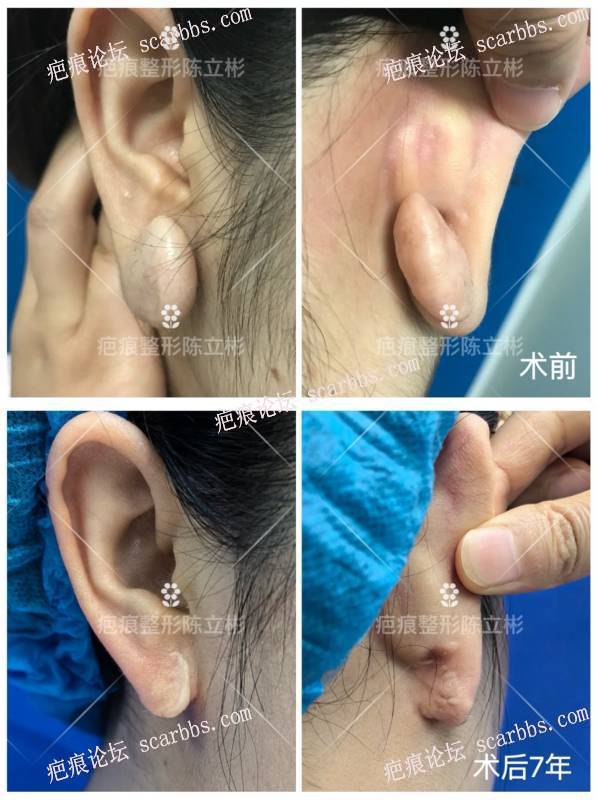 耳部疤痕疙瘩患者术后7年反馈 