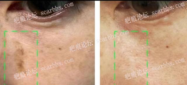 脸上凹陷疤痕也是色素疤痕治疗效果分享