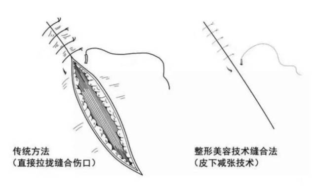 比较久的凹陷疤痕可以修复吗？ 