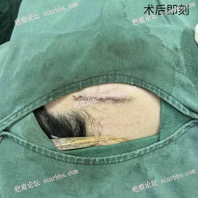 4月29日去重庆杨教授那做的面部疤痕切除 