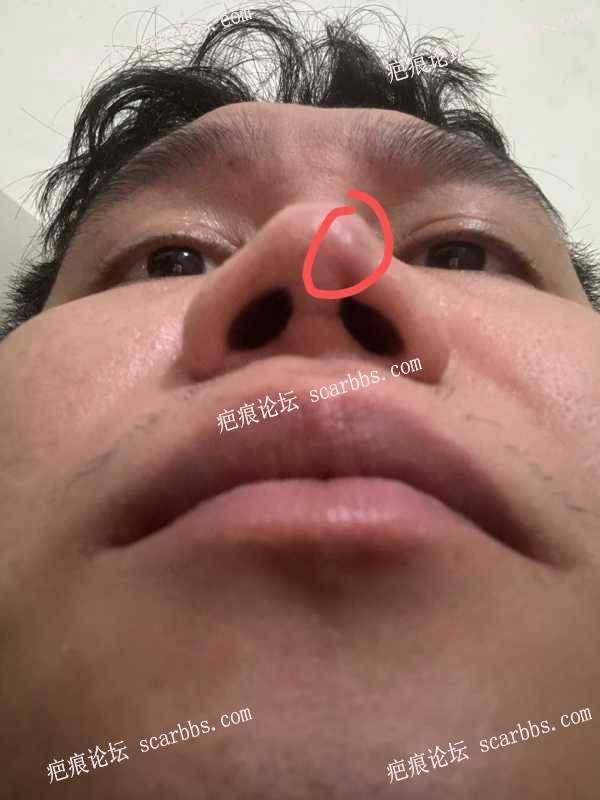 请问我鼻尖上的是疤痕吗？ 