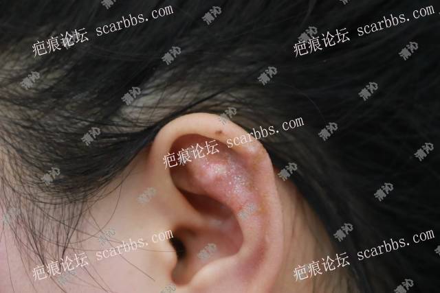 耳廓疤痕修复案例