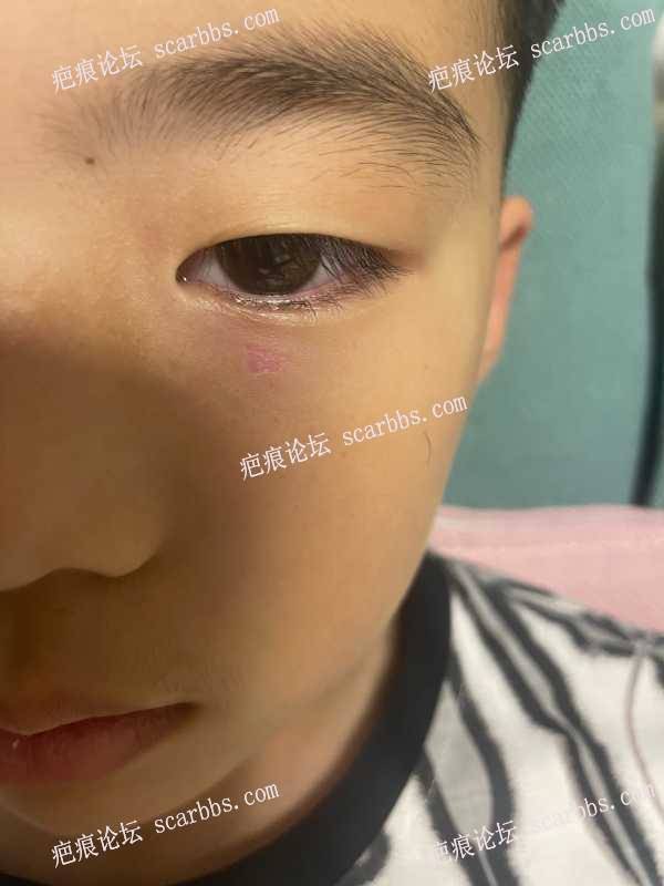 小孩眼部下面被同学挖伤