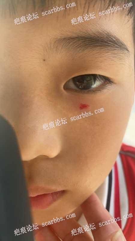 小孩眼部下面被同学挖伤 