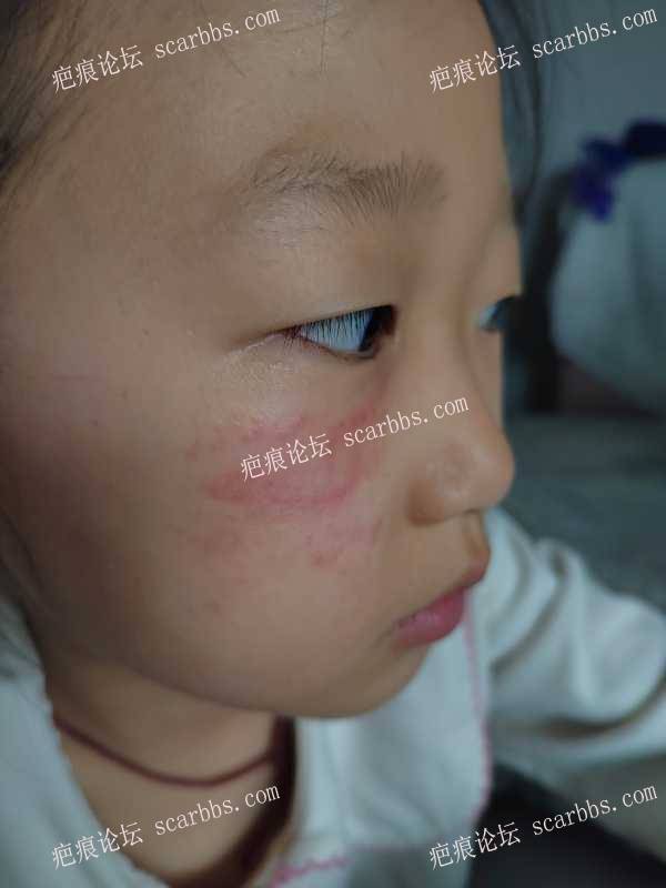 女儿脸上近期划伤，求护理方法 