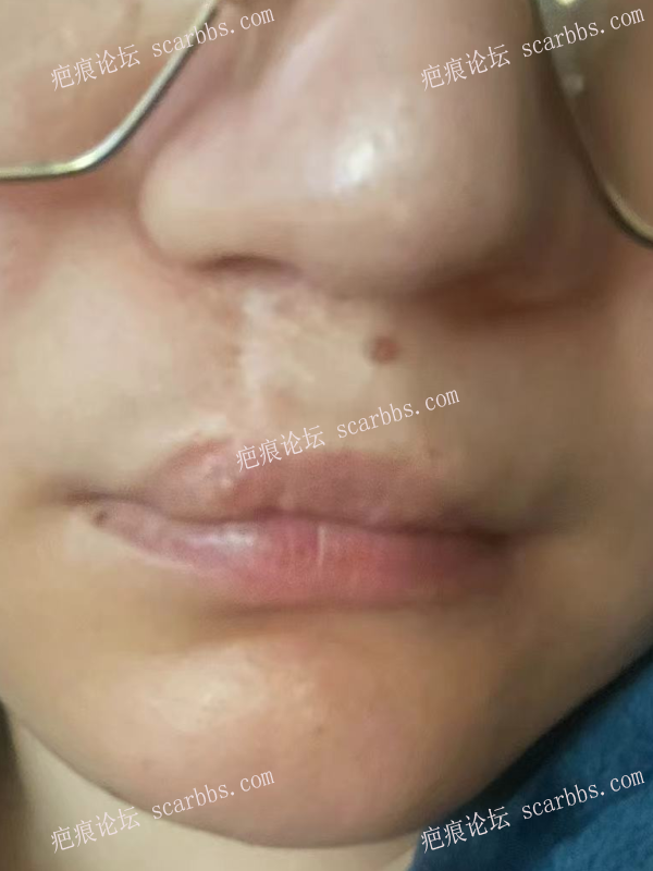 唇裂二次修复后白唇疤痕如何治疗 