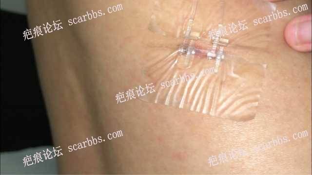 李斌医生切除腰部疤痕手术 