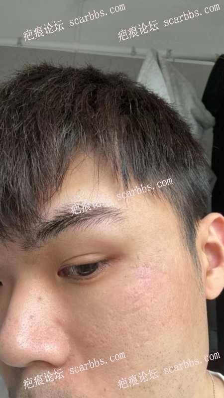 脸上凹陷疤痕做了切缝手术 