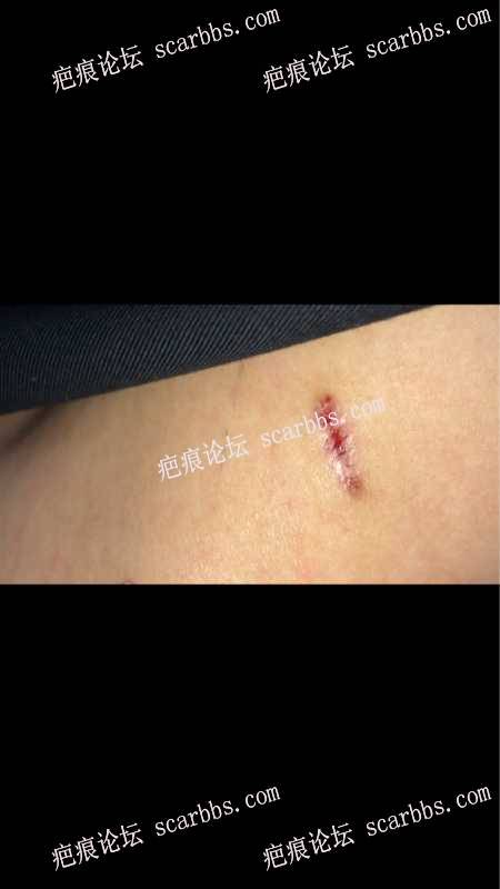 李斌医生切除腰部疤痕手术 