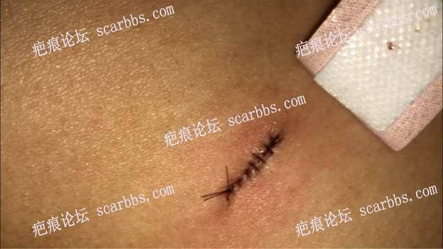 李斌医生切除腰部疤痕手术 