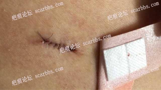 李斌医生切除腰部疤痕手术 