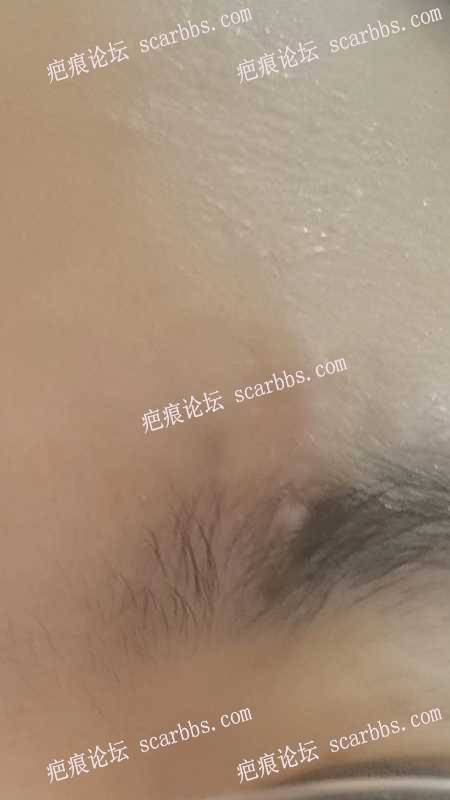 2024年4月1日杨东运医疗诊所切缝眉头部位凹陷疤痕手术 