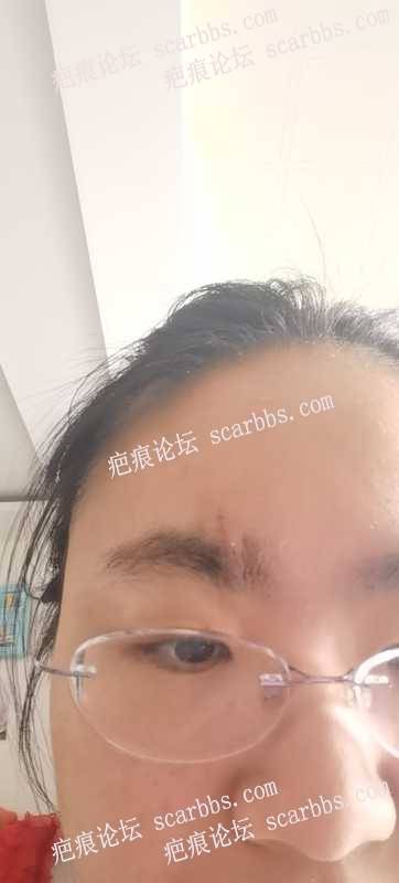 2024年4月1日杨东运医疗诊所切缝眉头部位凹陷疤痕手术 