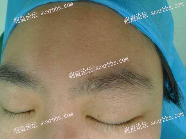 2024年4月1日杨东运医疗诊所切缝眉头部位凹陷疤痕手术