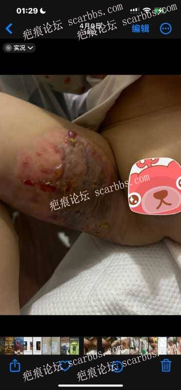 儿童烫伤腿部，求抗疤痕方法 