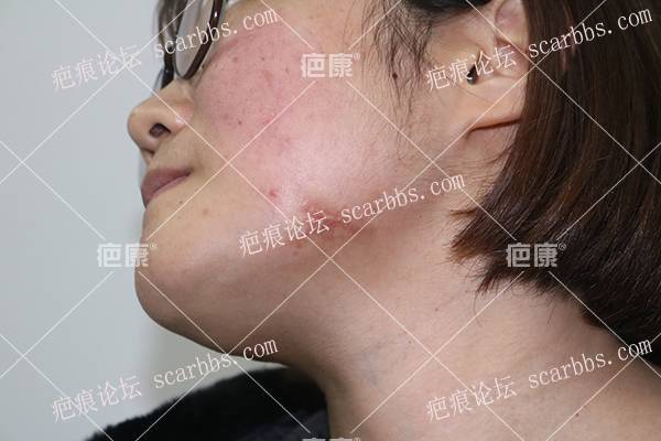 河北董女士颌下、前胸4年疤痕疙瘩治疗案例 