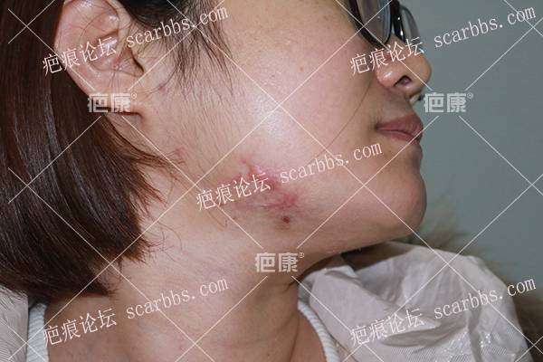 河北董女士颌下、前胸4年疤痕疙瘩治疗案例 