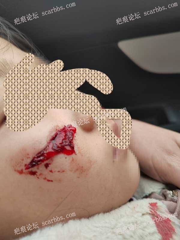 女儿脸上近期划伤，求护理方法 
