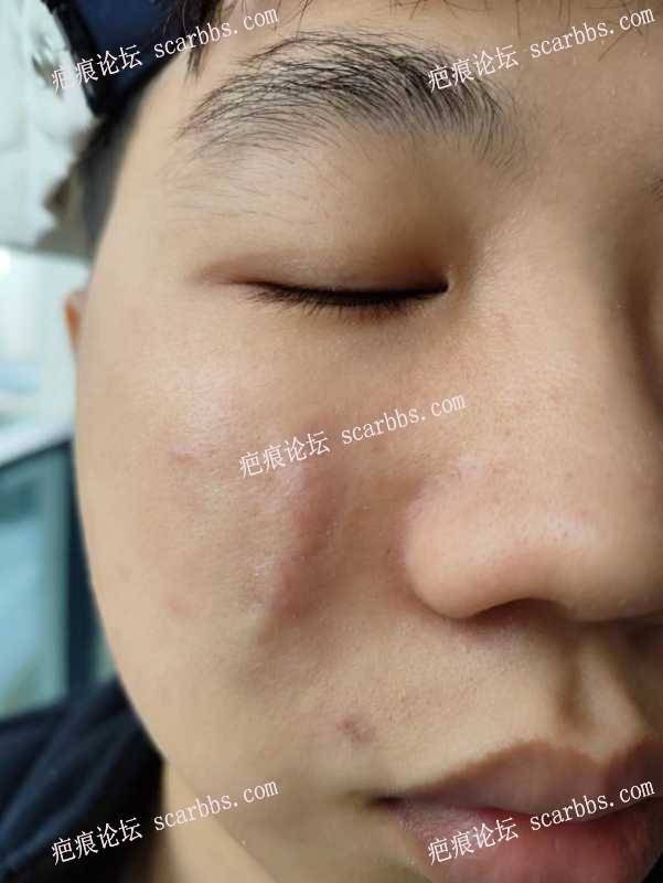 凹陷疤痕3月5日在上海陈立彬医生 