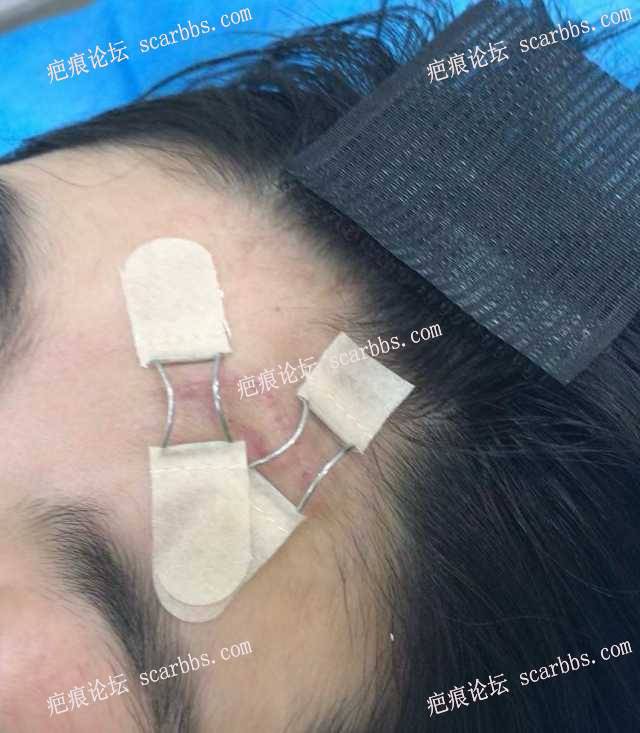 3月25日杨教授面部额头疤痕修复 