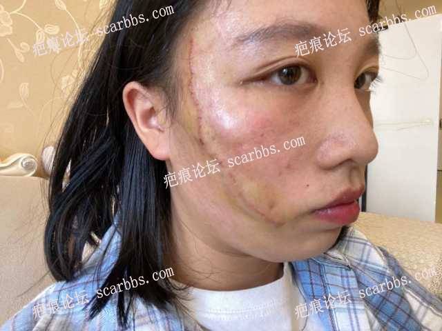 脸上长疤痕做了切缝手术，后期需要如何防护 
