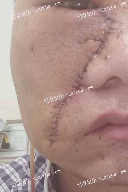 脸上长疤痕做了切缝手术，后期需要如何防护 