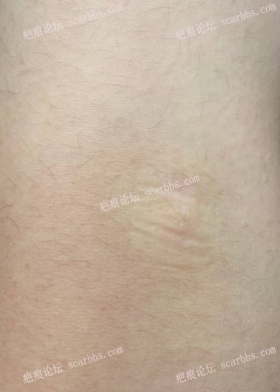 膝盖处的疤痕疙瘩贴了5年美皮护后的变化 