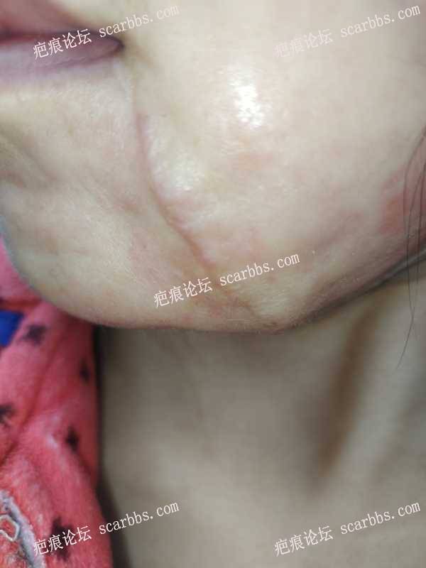 面部长疤痕东上医疗美容切缝术后反馈 