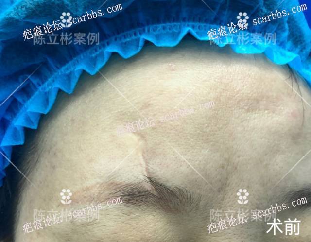 面部疤痕患者术后7个月反馈 