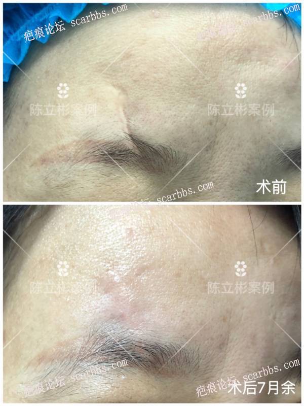 面部疤痕患者术后7个月反馈 