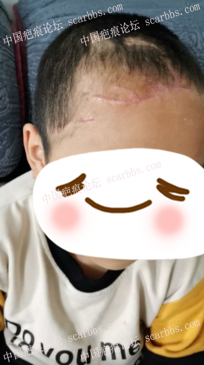 孩子头部被狗咬伤留下疤痕，还能治好吗？ 