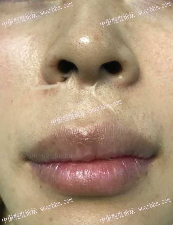上唇伴右侧鼻部疤痕修复过程 