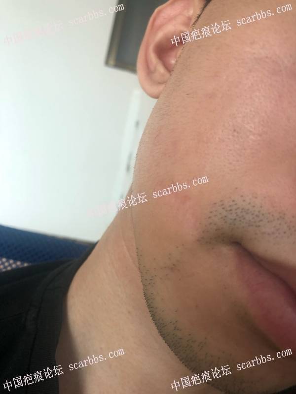 面部凹陷疤痕，广州中山三院（胡瑛）做的疤痕切缝手术 