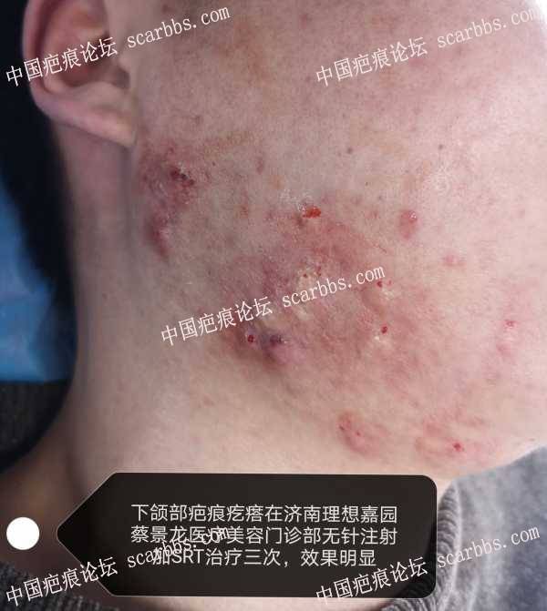 下颌部疤痕疙瘩早期治疗 腮部疤痕疙瘩,SRT浅层放射