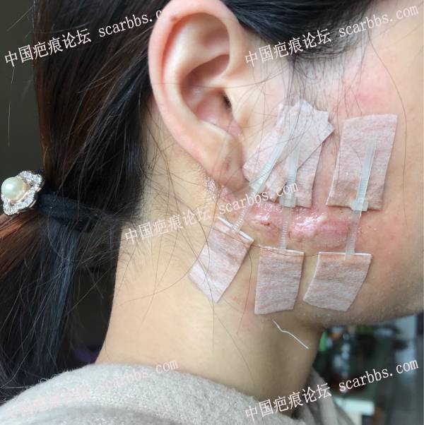 9.29杨教授处做的面部疤痕疙瘩切除手术 